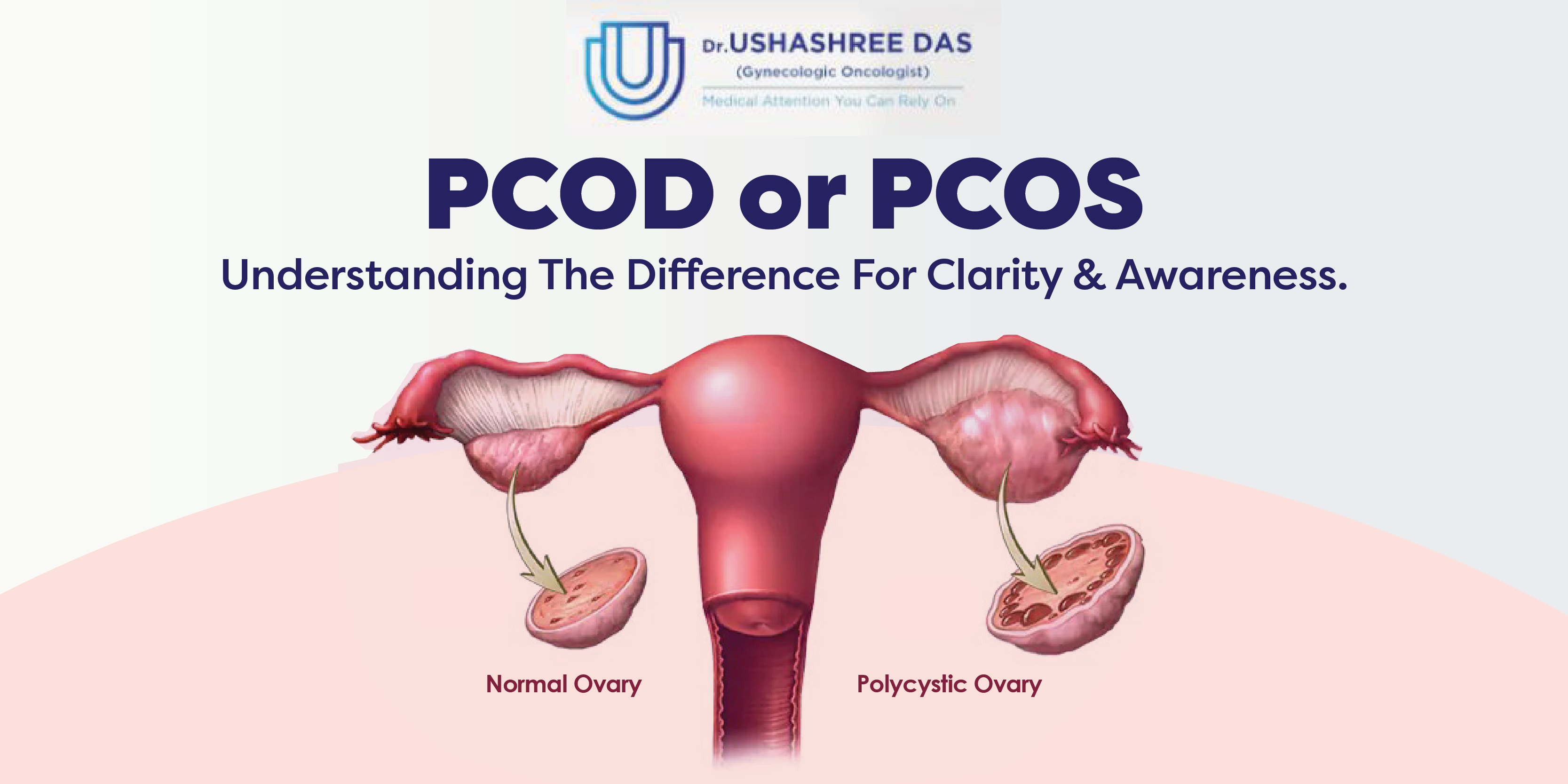 PCOD vs PCOS: What Is The Difference?
