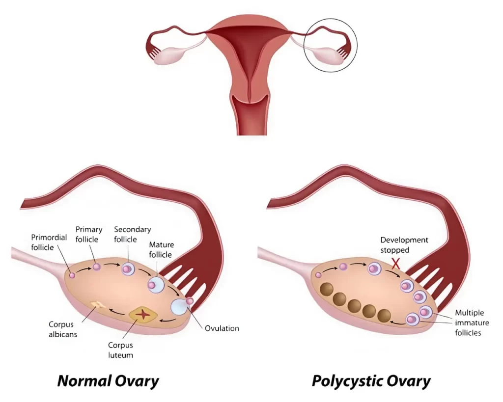 Normal Ovary vs Polycystic Ovary PCOS